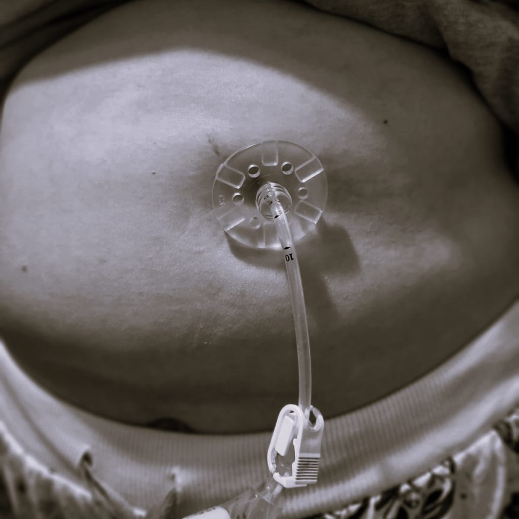 Greyscale photo of Helen's tummy and her feeding tube